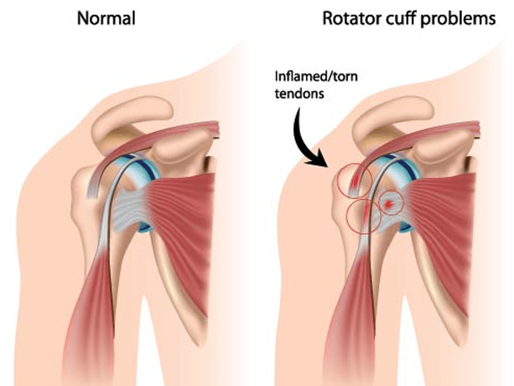 shoulder